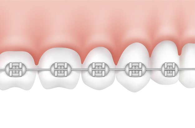 Vector human teeth with metal braces side view isolated on white background