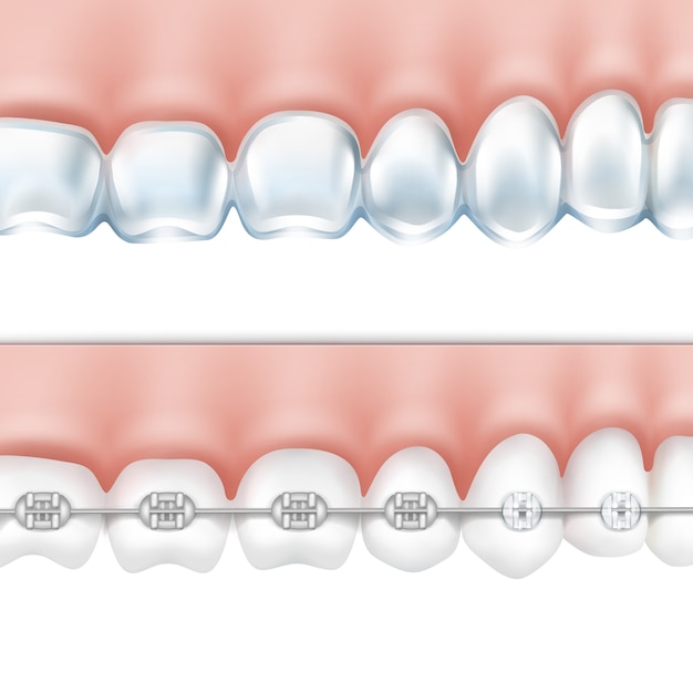 Vector human teeth with metal braces and whitening tray side view isolated on white background