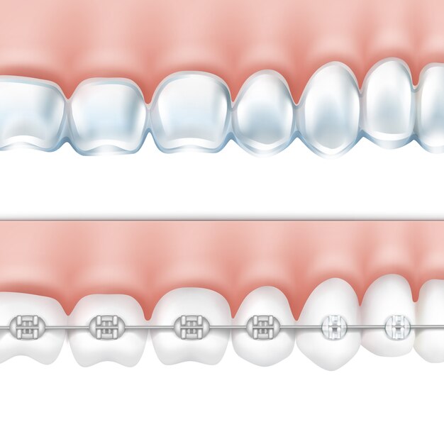 Вектор человеческие зубы с металлическими брекетами и отбеливающий лоток, вид сбоку, изолированные на белом фоне
