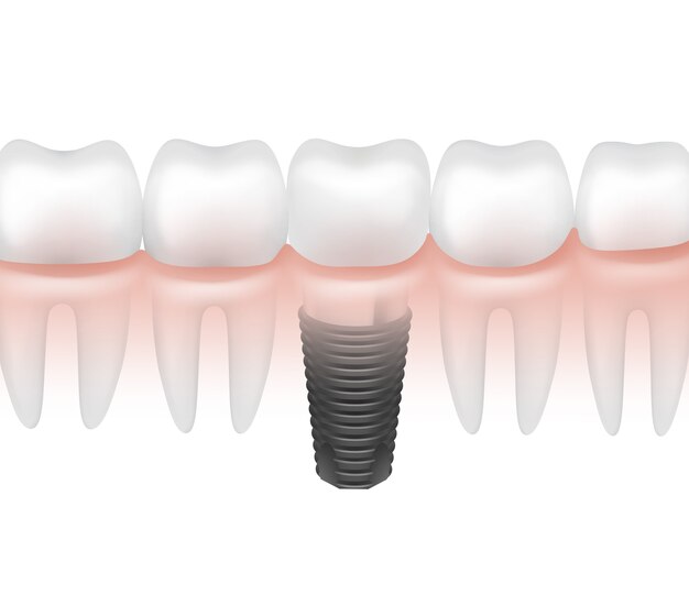 白い背景で隔離の歯茎側面図で他の歯の間のベクトル金属歯科インプラント