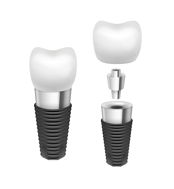 Vector metal disassembled tooth implant side view isolated on white background