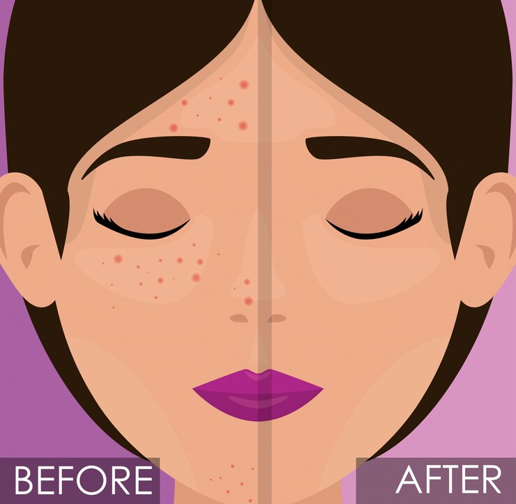 Free Vector woman before and after skin treatment