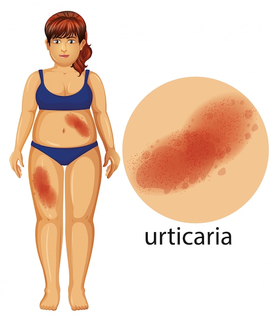 Free vector woman with urticaria problem