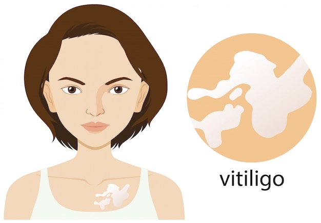 Free vector woman with vitiligo condition