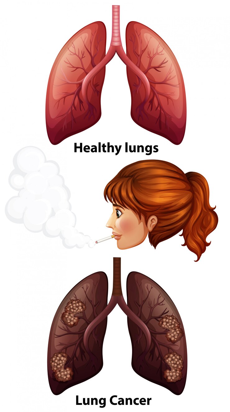 मुफ़्त वेक्टर women smoking with healthy and cancer lungs