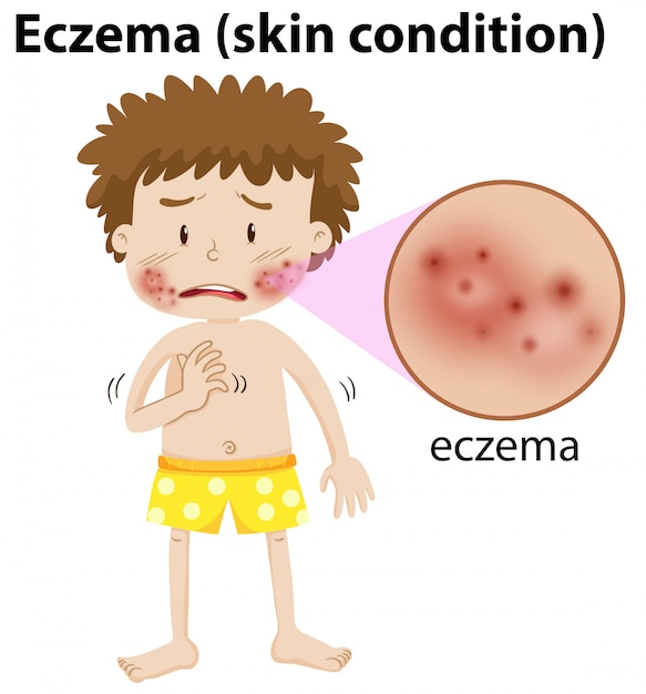 Un giovane ragazzo che ha l'eczema