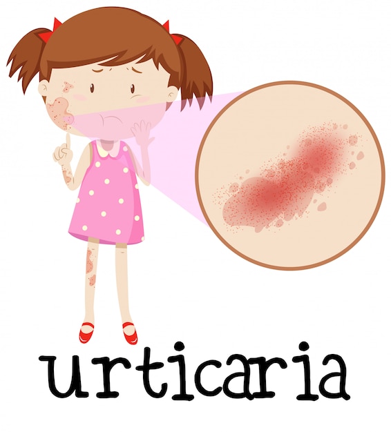 Giovane ragazza con orticaria