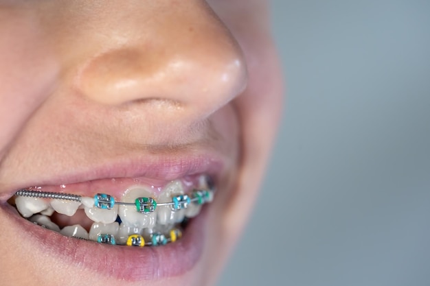 Photo gratuite adolescente avec des accolades sur ses dents libre d'un sourire