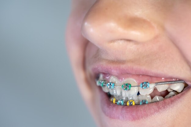 Une adolescente avec des appareils orthopédiques sur ses dents, un gros plan d'un sourire.