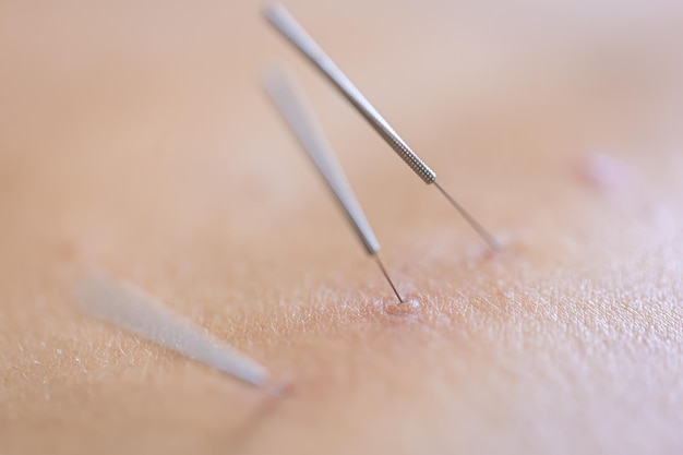 Photo gratuite aiguilles d'acupuncture à aiguilles sèches sur le patient de près