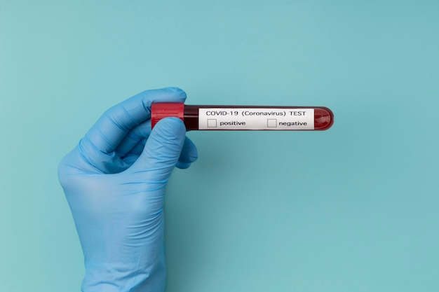 Photo gratuite arrangement d'échantillon de sang de coronavirus en laboratoire