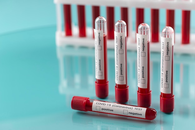 Arrangement d'échantillons de sang de coronavirus en laboratoire