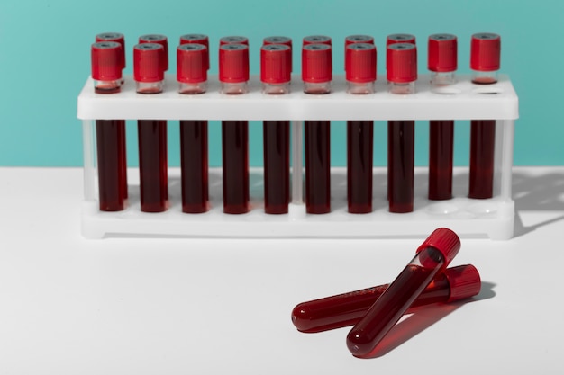Assortiment d'échantillons de sang de coronavirus en laboratoire