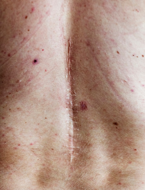 Photo gratuite cicatrice de chirurgie du dos chez une personne âgée