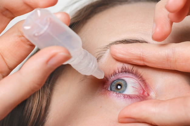 Close up femelle verse des gouttes dans les yeux rouges, a une conjonctivite ou un glaucome, une mauvaise vue et de la douleur. Concept de traitement de la douleur des yeux. Femme guérit les yeux rouges