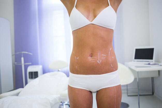 Corps féminin avec les flèches de dessin pour l'abdomen pour la liposuccion et l'élimination de la cellulite