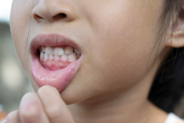 Portrait D Une Petite Fille Mignonne Montrant Ses Dents Cassees Photo Premium