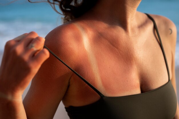 Détails de la peau des coups de soleil d'une femme du soleil de la plage