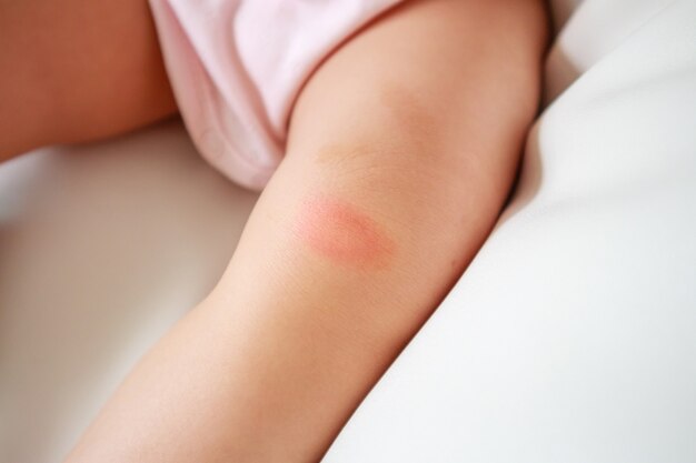 Images Dermatite Enfant Vecteurs Photos Et Psd Gratuits