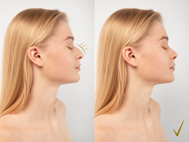 Femme se prépare pour la chirurgie du nez