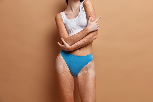 Gros plan sur une femme mince avec une peau de vitiligo