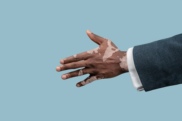 Gros plan des mains masculines avec des pigments de vitiligo isolés sur fond bleu studio.