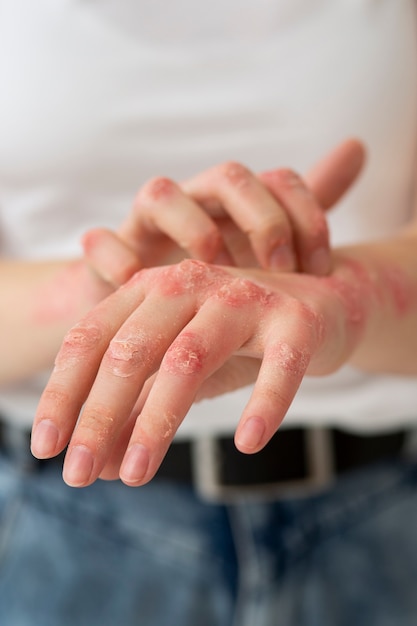 Mains d'un patient souffrant de psoriasis