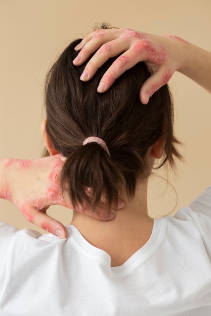 Photo gratuite mains d'un patient souffrant de psoriasis