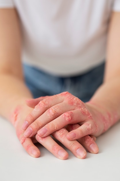 Mains d'un patient souffrant de psoriasis