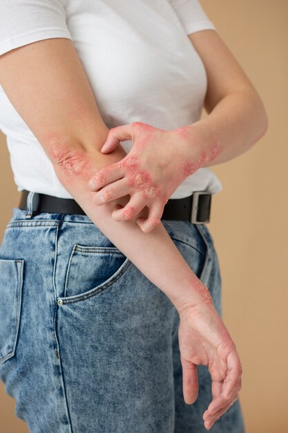 Mains d'un patient souffrant de psoriasis