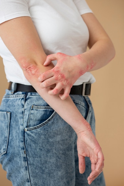 Mains d'un patient souffrant de psoriasis