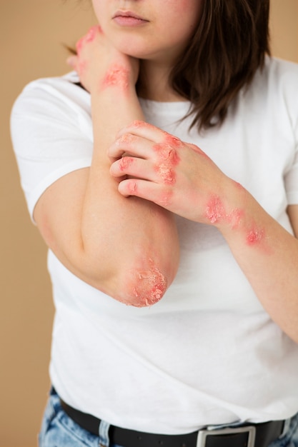 Mains d'un patient souffrant de psoriasis