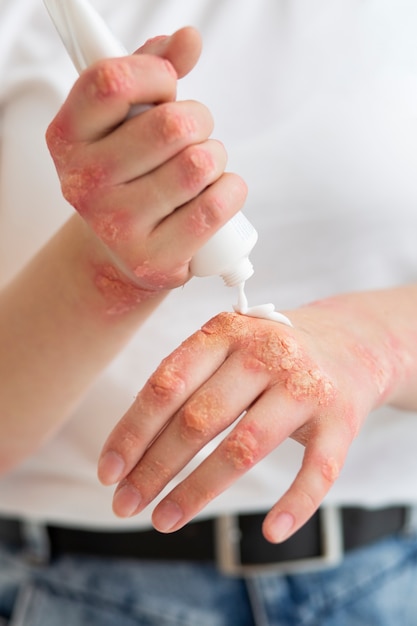 Mains d'un patient souffrant de psoriasis