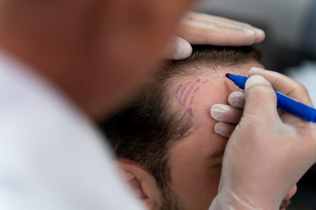 Photo gratuite mâle adulte faisant une extraction d'unité folliculaire