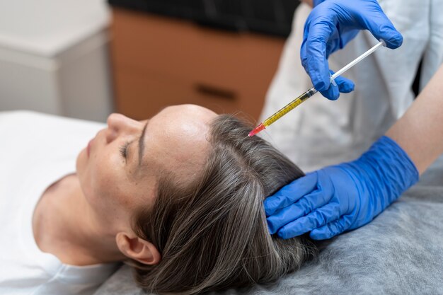 Patient à angle élevé recevant une injection de prp pour l'alopécie