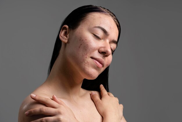 Portrait de la belle jeune femme avec l'acné