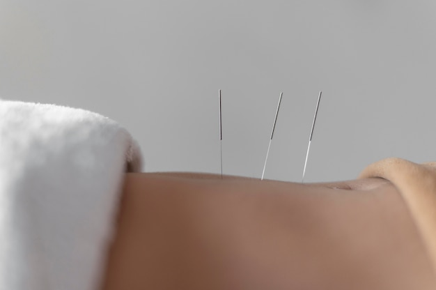 Photo gratuite procédure d'acupuncture en gros plan