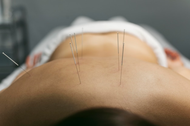 Photo gratuite processus d'acupuncture pour le client