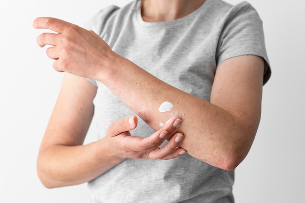Réaction d'allergie cutanée sur le bras de la personne