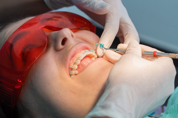 Retrait des élastiques des appareils dentaires en train de retirer les appareils dentaires d'une fille de race blanche dans une clinique dentaire avec une femme dentiste
