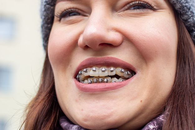 Système de support dans la bouche souriante d'une fille, macrophotographie des dents. grand visage et lèvres peintes