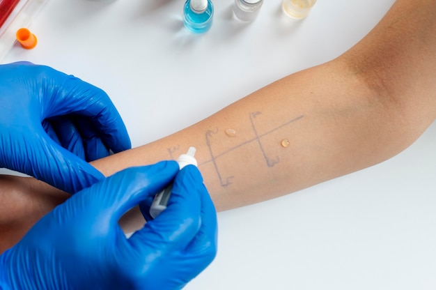 Test de réaction allergique cutanée sur le bras d'une personne