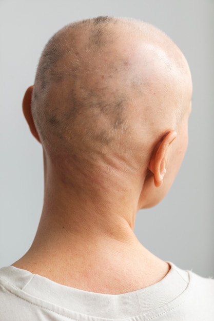 Vue arrière femme atteinte d'un cancer de la peau