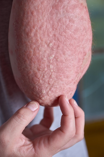 Photo gratuite vue de l'avant-bras avec psoriasis