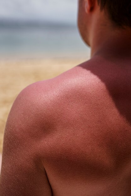 Vue d'un homme avec une peau de coup de soleil à la plage