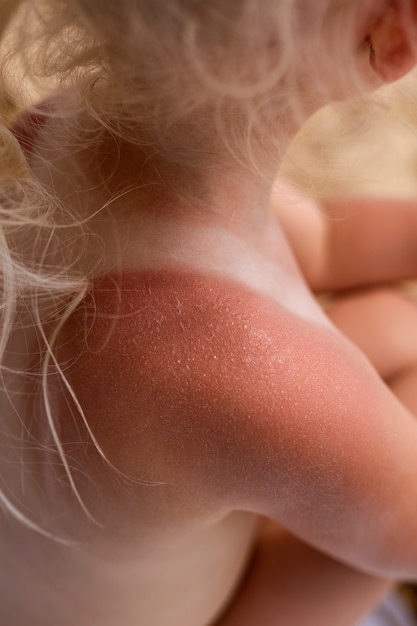 Photo gratuite vue de jeune fille avec la peau de coup de soleil à la plage