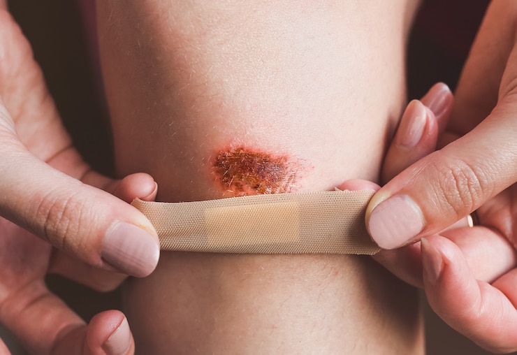 Photo abrasion sur le genou de la femme. la fille applique un pansement antiseptique sur la jambe blessée avec une plaie rouge. traitement médical.