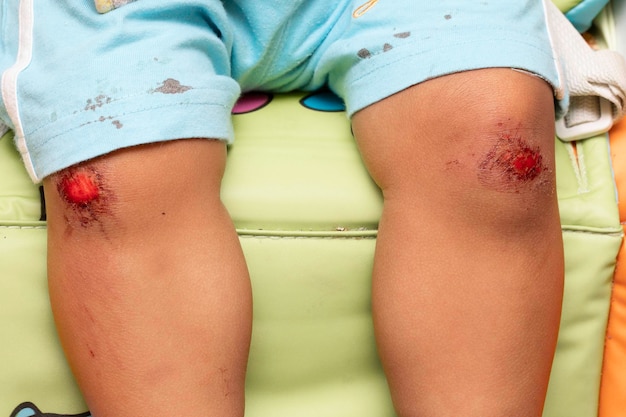 Photo une abrasion infantile au genou, une blessure d'enfant en gros plan.