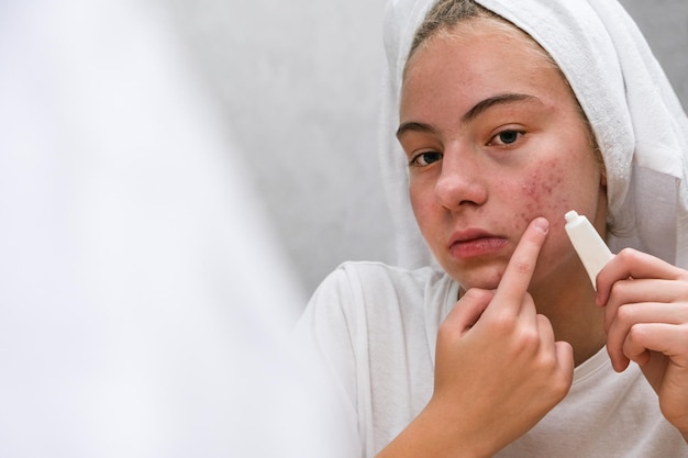 Acné. Une adolescente qui applique des médicaments contre l'acné sur son visage devant un miroir. Soin des peaux à problèmes