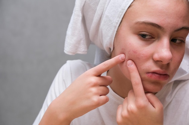 Photo l'acné d'une adolescente qui s'est débarrassée d'un pimple sur le visage devant un miroir. peau problématique.